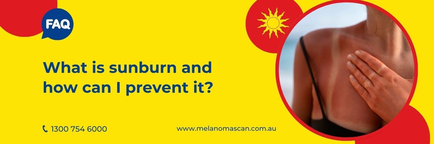 how to prevent sun burn