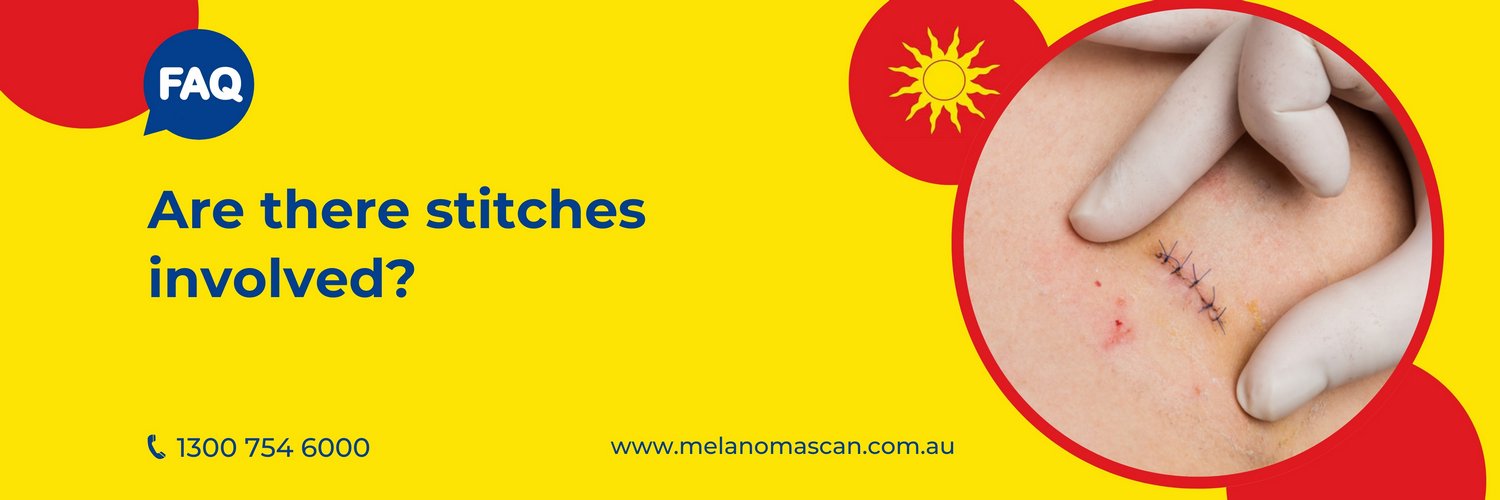 stitches for closure of ellipse excisions