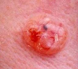 Basal Cell Carcinoma - Types of Skin Cancer