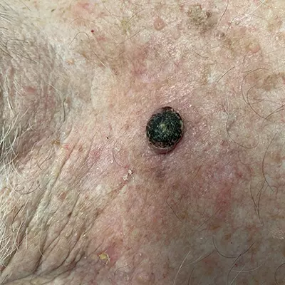 Keratoacanthoma - Skin Cancer Type