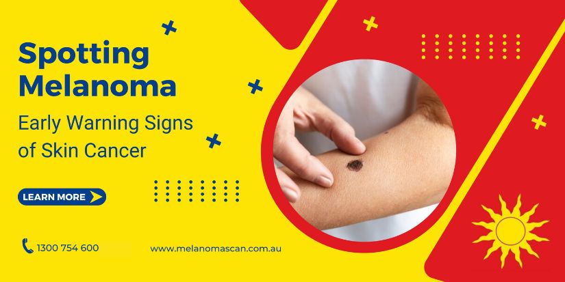Spotting Melanoma Early Warning Signs of Skin Cancer