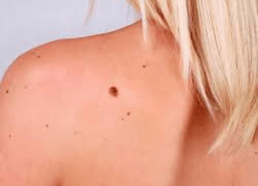 Signs of Skin Cancer in Moles