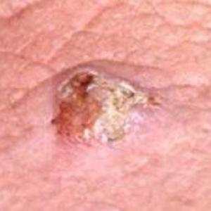 Squamous Cell Carcinoma - Skin Cancer Type